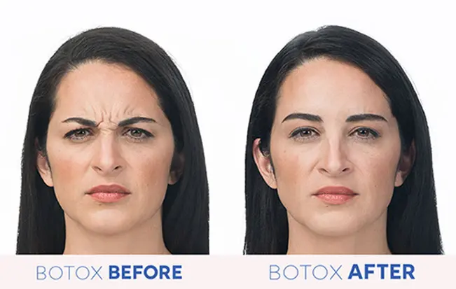 How To Prepare For Botox